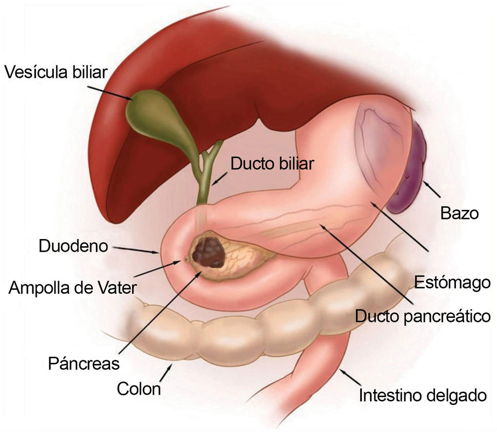 Puede haber piedras en el pancreas